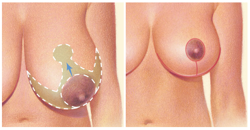 breast-reduction-incisions-2