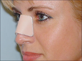 nose-plastic-surgery