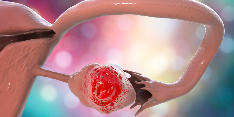 Καρκίνος ωοθηκών: Παράγοντες κινδύνου & Συμπτώματα