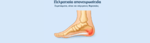 πελματιαία απονευρωσίτιδα