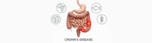 Νόσος Crohn & διατροφή: 7 τροφές 'παγίδες' που μπορούν να πυροδοτήσουν κρίσεις